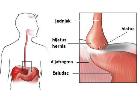 Izgled hijatus hernije