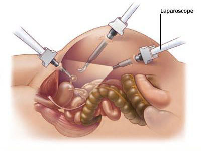 Laparoskopija