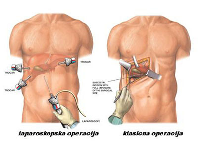 Laparoskopska vs klasična operacija