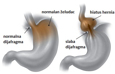 Normalan želudac / Hijatus hernija