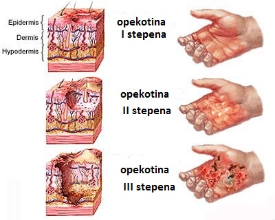 Stepeni opekotina