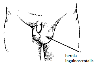 hernija-trbuh